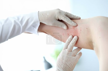 Photo for Male doctor in white latex gloves examines patient with skin disease against office background. Allergy treatment concept - Royalty Free Image