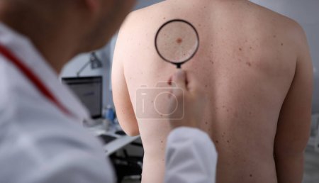 Téléchargez les photos : Homme médecin regarder loupe sur la peau du patient sur fond de bureau de l'hôpital. Lésions danger problème thérapie concept - en image libre de droit