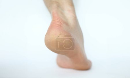 Photo for Close-up view of persons crack on heel. Dry badly cared foot. Health and dermatology problems concept. Barefoot woman or man. Part of human body. Isolated on white - Royalty Free Image