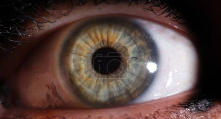 Primer plano del ojo rojo dañado o irritado. Córnea ocular con concepto de vasos rojos