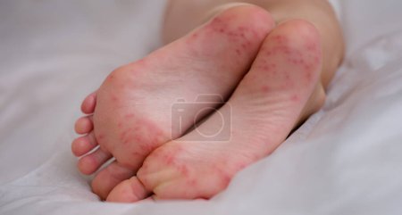Foto de Sarpullido doloroso manchas rojas ampollas en la pierna del niño. Niños piel con dermatitis eccema y enfermedad viral - Imagen libre de derechos