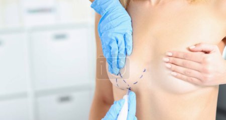 Téléchargez les photos : Le médecin trace des marques sur le sein féminin avant l'opération de chirurgie esthétique. Elargissement et élévation du concept des glandes mammaires féminines - en image libre de droit
