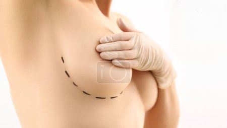 Photo for Woman Breasts Plastic Surgery Marker Line Mark. Topless Female with Lines on Skin for Operation on White Background. Lines on Girl Body for Medical Bust Improvement Procedure Partial View Shot - Royalty Free Image