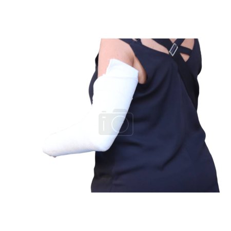 Foto de Imagen de cerca del brazo de una mujer en un yeso médico blanco - Imagen libre de derechos