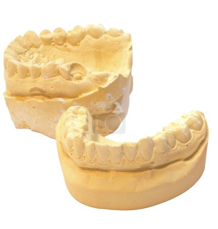 Modelo de yeso dental detallado y preciso para estudio y diagnóstico de ortodoncia sobre fondo blanco