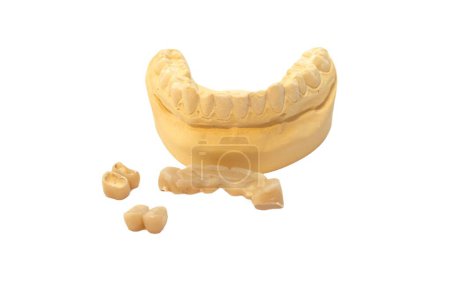 Conjunto de impresiones dentales de mandíbula superior e inferior con dientes protésicos extraíbles aislados