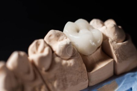 Téléchargez les photos : Moule de dents. Modèle de gypse plâtre des dents. Coulée de plâtre stomatologique, moules des mâchoires et des dents humaines sur fond noir. Concept de dentisterie et d'orthodontie. - en image libre de droit