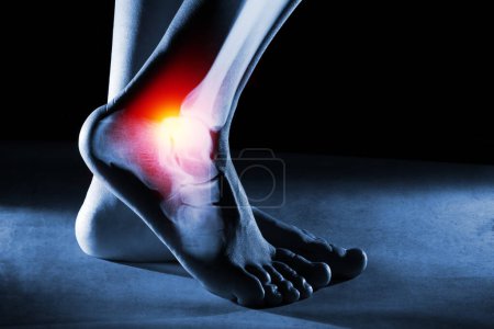 Téléchargez les photos : Cheville et jambe du pied humain en radiographie sur fond bleu. La cheville du pied est soulignée par une couleur rouge-jaune. - en image libre de droit