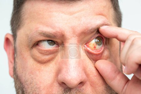 Rötung des Auges, mögliche Folgen eines Kapillarrisses oder einer Infektion, sichtbare Blutungen. Nahaufnahme des Gesichts eines Mannes.