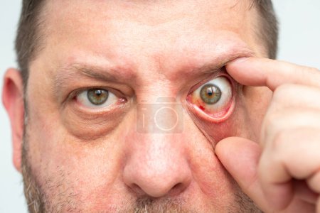 Enrojecimiento del ojo, posibles consecuencias de rotura capilar o infección, hemorragia visible. Primer plano de la cara de un hombre.