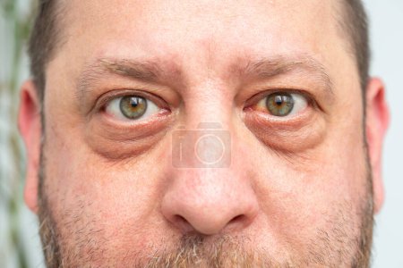 Primer plano de la cara de un hombre: hemorragia visible y enrojecimiento del ojo, posibles consecuencias de la ruptura capilar o infección.