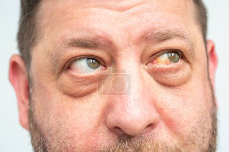 Gros plan du visage d'un homme : hémorragie visible et rougeur de l'?il, conséquences possibles d'une rupture capillaire ou d'une infection.