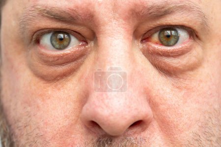 Téléchargez les photos : Rougeur de l'œil, conséquences possibles d'une rupture capillaire ou d'une infection, hémorragie visible. Gros plan du visage d'un homme. - en image libre de droit