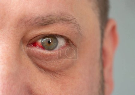 Blutungen durch Kapillarriss im Auge des Mannes. Detaillierte Abbildung des Gesichts eines Mannes mit geröteten Augen.