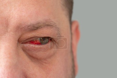 Hemorragia debida a ruptura capilar en el ojo del hombre. Imagen detallada de la cara de un hombre con un ojo enrojecido.