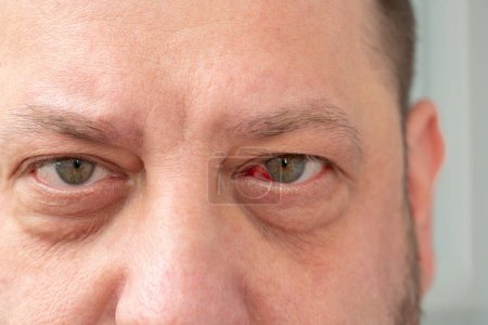 Hemorragia debida a ruptura capilar en el ojo del hombre. Imagen detallada de la cara de un hombre con un ojo enrojecido.