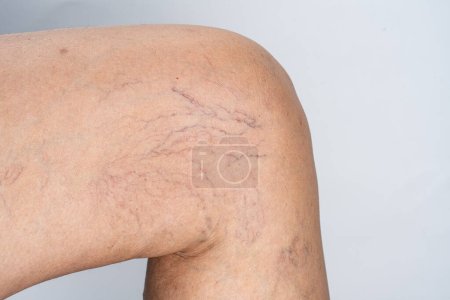 Foto de Venas varicosas en la pierna femenina - Imagen libre de derechos