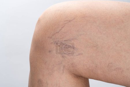 Téléchargez les photos : Varices sur la jambe féminine - en image libre de droit