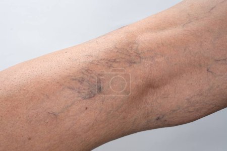 Téléchargez les photos : Varices sur la jambe féminine - en image libre de droit