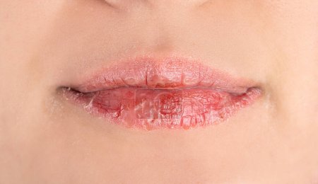 Getrocknete und rissige weibliche Lippen
