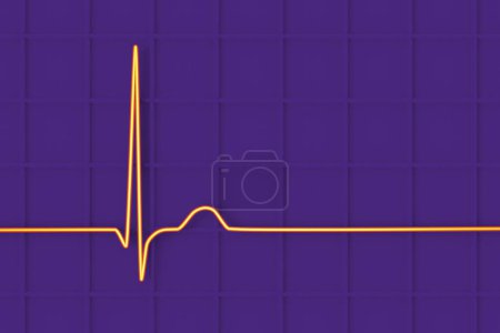 Foto de Ilustración de un electrocardiograma (ECG) que muestra un ritmo de unión del latido del corazón. - Imagen libre de derechos