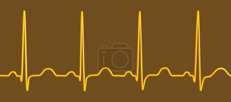 Foto de Ilustración de un electrocardiograma (ECG) que muestra taquicardia sinusal, un ritmo cardíaco común caracterizado por una frecuencia cardíaca superior al límite superior de la normalidad (90-100 lpm en adultos). - Imagen libre de derechos