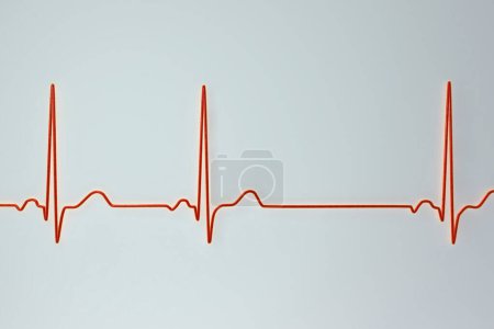 Photo for Illustration of an electrocardiogram (ECG) displaying sinus arrhythmia, a condition characterised by irregular heart rhythms originating from the sinus node. - Royalty Free Image