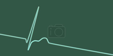Téléchargez les photos : Illustration d'un électrocardiogramme (ECG) montrant un rythme conjonctif du rythme cardiaque. - en image libre de droit