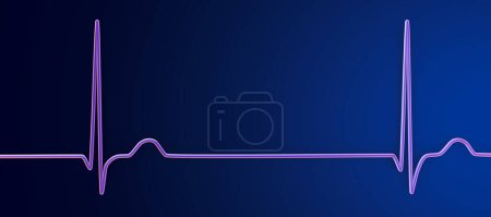 Photo for Illustration of an electrocardiogram (ECG) displaying a junctional rhythm of the heartbeat. This abnormal rhythm occurs when the electrical signals in the heart originate from the atrioventricular node instead of the sinoatrial node. - Royalty Free Image
