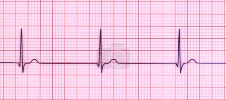 Foto de Ilustración de un electrocardiograma (ECG) que muestra un ritmo de unión del latido del corazón. Este ritmo anormal ocurre cuando las señales eléctricas en el corazón se originan en el ganglio auriculoventricular en lugar del ganglio sinoauricular.. - Imagen libre de derechos