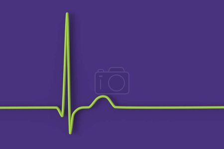 Foto de Ilustración de un electrocardiograma (ECG) que muestra un ritmo de unión del latido del corazón. Este ritmo anormal ocurre cuando las señales eléctricas en el corazón se originan en el ganglio auriculoventricular en lugar del ganglio sinoauricular.. - Imagen libre de derechos