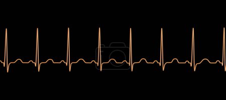 Téléchargez les photos : Illustration d'un électrocardiogramme (ECG) montrant une tachycardie sinusale, un rythme cardiaque fréquent caractérisé par une fréquence cardiaque supérieure à la limite supérieure de la normale (90-100 bpm chez l'adulte)). - en image libre de droit