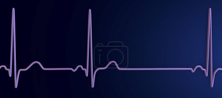 Téléchargez les photos : Illustration d'un électrocardiogramme (ECG) présentant une arythmie sinusale, une affection caractérisée par des rythmes cardiaques irréguliers provenant du nœud sinusal. - en image libre de droit