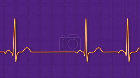 Photo for Illustration of an electrocardiogram (ECG) displaying sinus arrhythmia, a condition characterised by irregular heart rhythms originating from the sinus node. - Royalty Free Image