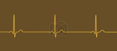 Téléchargez les photos : Illustration d'un électrocardiogramme (ECG) montrant une bradycardie sinusale. Cette condition est caractérisée par une fréquence cardiaque lente provenant du noeud sinusal, généralement inférieure à 60 battements par minute. - en image libre de droit