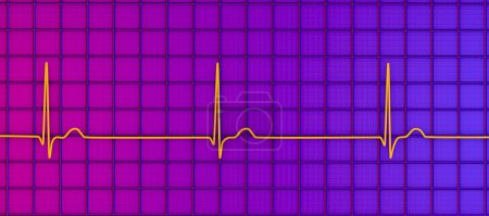 Téléchargez les photos : Illustration d'un électrocardiogramme (ECG) montrant un rythme conjonctif du rythme cardiaque. Ce rythme anormal se produit lorsque les signaux électriques dans le cœur proviennent du noeud auriculo-ventriculaire au lieu du noeud sinoauriculaire. - en image libre de droit