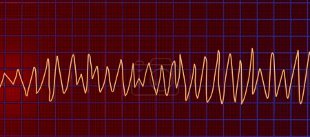 Foto de Ilustración de un electrocardiograma (ECG) que muestra el ritmo de Torsades de pointes. Se trata de un ritmo cardíaco anormal caracterizado por latidos rápidos e irregulares que se retuercen alrededor del eje eléctrico y que pueden causar desmayos o paro cardíaco.. - Imagen libre de derechos