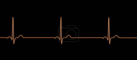 Photo for Illustration of an electrocardiogram (ECG) showing sinus bradycardia. This condition is characterised by a slow heart rate originating from the sinus node, typically below 60 beats per minute. - Royalty Free Image