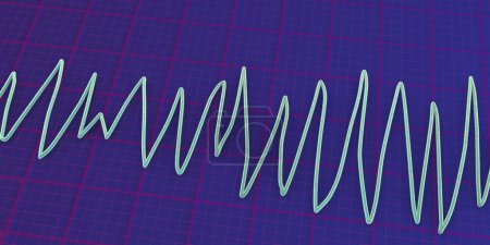 Photo for Illustration of an electrocardiogram (ECG) showing Torsades de pointes rhythm. - Royalty Free Image