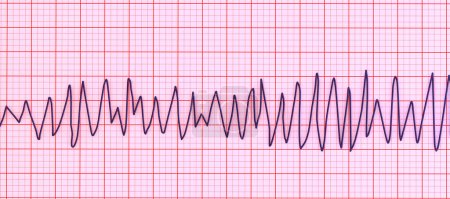 Téléchargez les photos : Illustration d'un électrocardiogramme (ECG) montrant le rythme des torsades de pointes. Il s'agit d'un rythme cardiaque dangereux caractérisé par des battements rapides et irréguliers tournant autour de l'axe électrique qui peuvent potentiellement causer des évanouissements ou un arrêt cardiaque.. - en image libre de droit