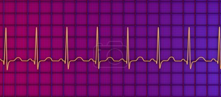 Photo for Illustration of an electrocardiogram (ECG) showing sinus tachycardia, a common cardiac rhythm characterised by a heart rate that is higher than the upper limit of normal (90-100 bpm in adults). - Royalty Free Image
