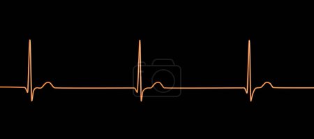 Téléchargez les photos : Illustration d'un électrocardiogramme (ECG) montrant un rythme conjonctif du rythme cardiaque. - en image libre de droit