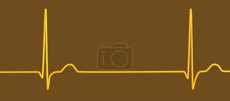 Photo for Illustration of an electrocardiogram (ECG) displaying a junctional rhythm of the heartbeat. - Royalty Free Image