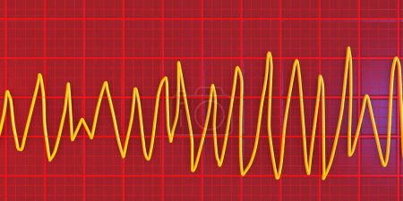 Foto de Ilustración de un electrocardiograma (ECG) que muestra el ritmo de Torsades de pointes. Se trata de un ritmo cardíaco peligroso caracterizado por latidos rápidos e irregulares que giran alrededor del eje eléctrico y que potencialmente pueden causar desmayos o paro cardíaco.. - Imagen libre de derechos