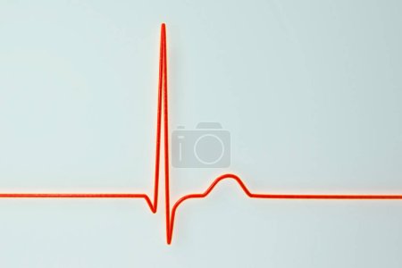 Téléchargez les photos : Illustration d'un électrocardiogramme (ECG) montrant un rythme conjonctif du rythme cardiaque. Ce rythme anormal se produit lorsque les signaux électriques dans le cœur proviennent du noeud auriculo-ventriculaire au lieu du noeud sinoauriculaire. - en image libre de droit