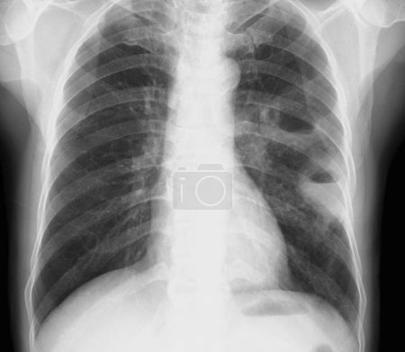 Photo for Chest X-ray of a 50 year old patient showing two cavities in the left lung (right) due to lung abscesses. An abscess is an accumulation of puss within a cavity in tissue. - Royalty Free Image