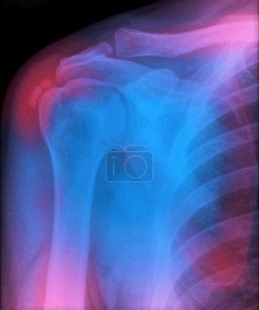Foto de Radiografía coloreada del hombro de un paciente con tendinitis calcifica. La tendinitis cálcica ocurre cuando hay una acumulación de depósitos de calcio en un tendón, generalmente el tendón del manguito rotador.. - Imagen libre de derechos