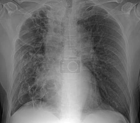Téléchargez les photos : Radiographie pulmonaire d'un patient atteint de bronchiectasie. La bronchiectasie est la dilatation et la distorsion permanentes des bronchioles (voies respiratoires pulmonaires). Il y a beaucoup de causes de cette condition, qui peuvent provenir de l'infection ou être une condition congénitale (Fro actuel - en image libre de droit