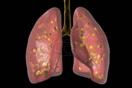 Téléchargez les photos : Histoplasmose pulmonaire, une infection fongique causée par Histoplasma capsulatum, illustration. - en image libre de droit