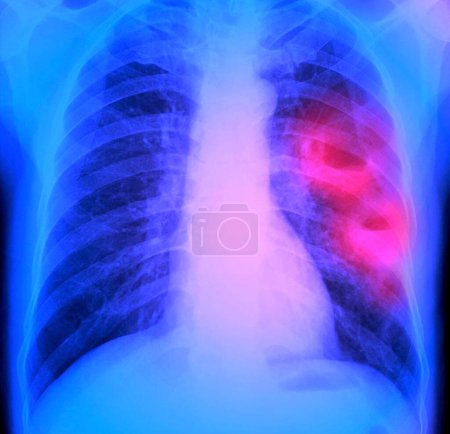 Foto de Radiografía de tórax coloreada de un paciente de 50 años que muestra dos cavidades (rosa) en el pulmón izquierdo (derecho) debido a abscesos pulmonares. Un absceso es una acumulación de pus dentro de una cavidad en el tejido. - Imagen libre de derechos